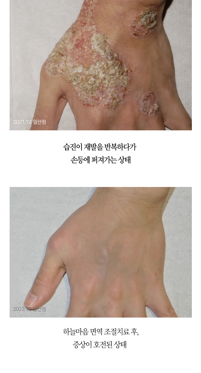 치료전후 이미지4