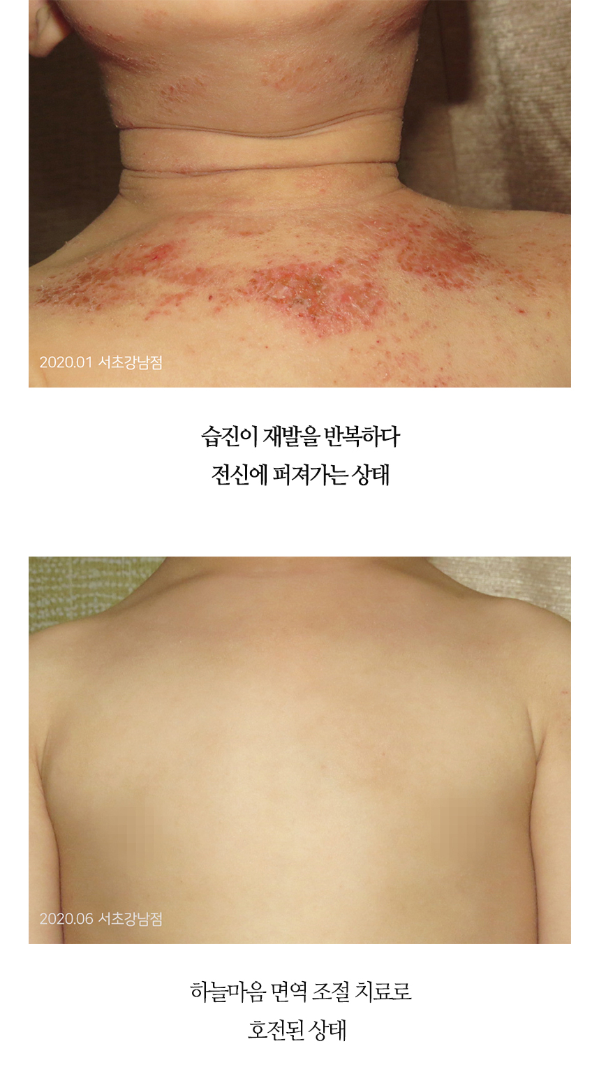 치료전후 이미지5