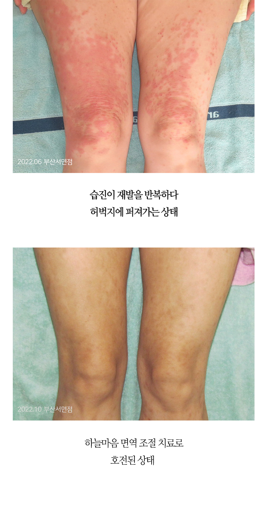 치료전후 이미지6