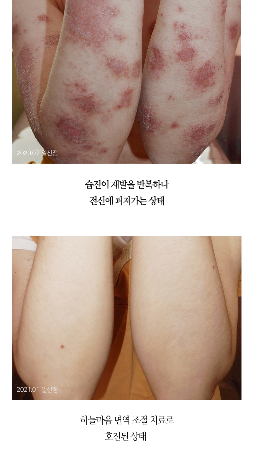치료전후 이미지7