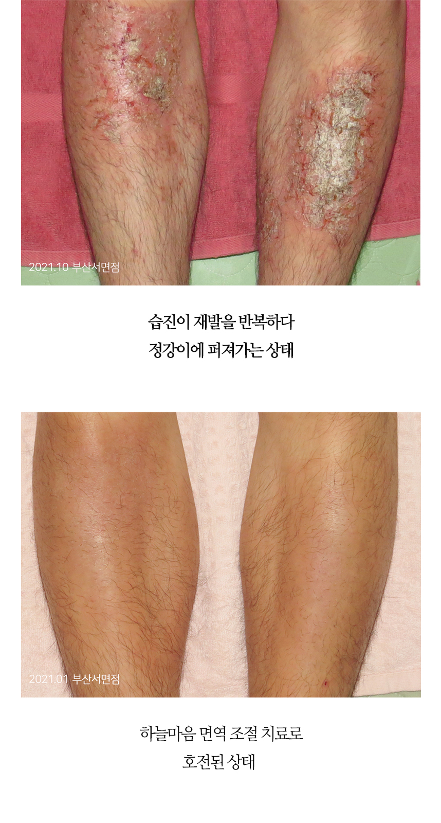 치료전후 이미지8