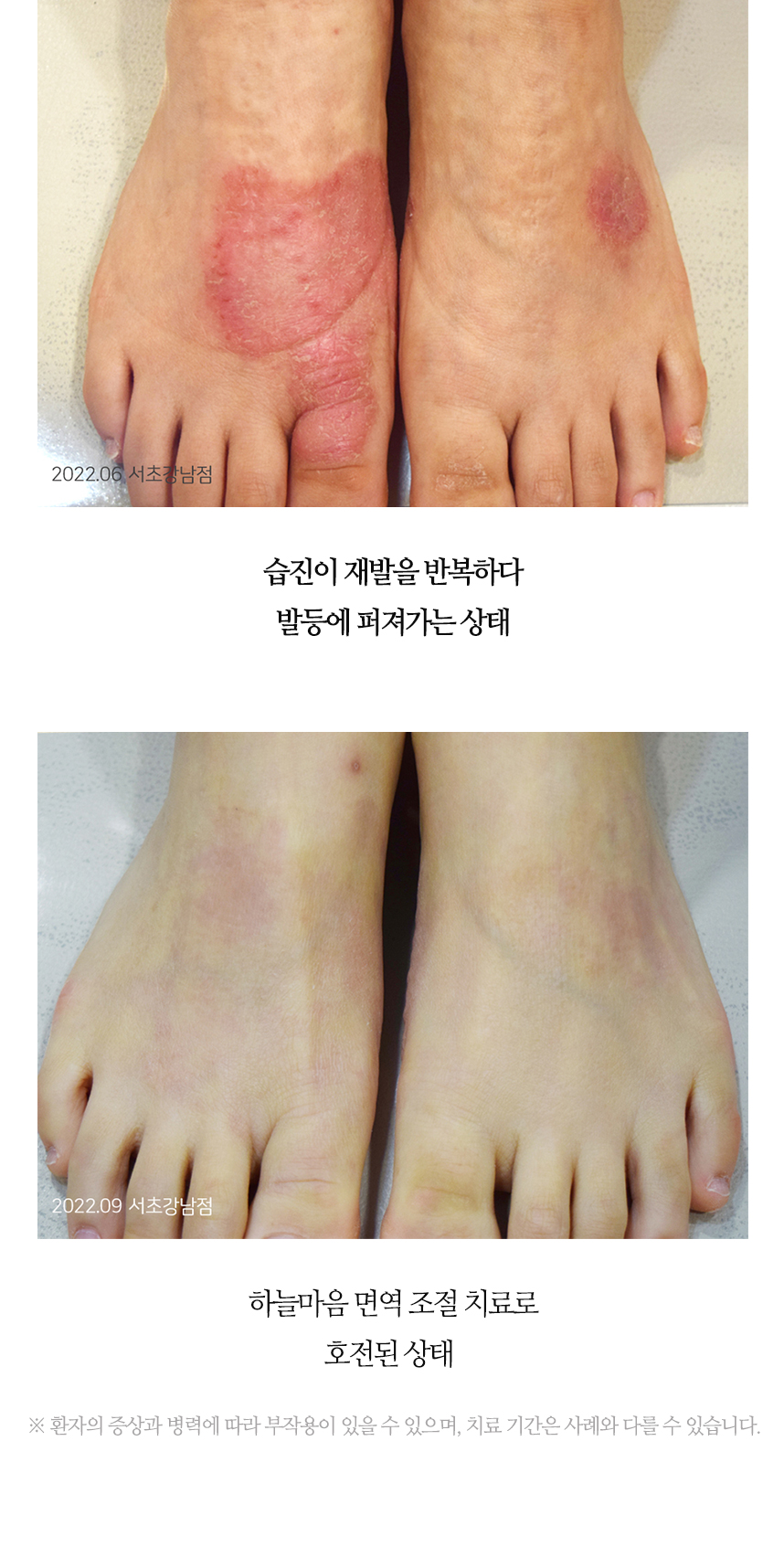 치료전후 이미지9