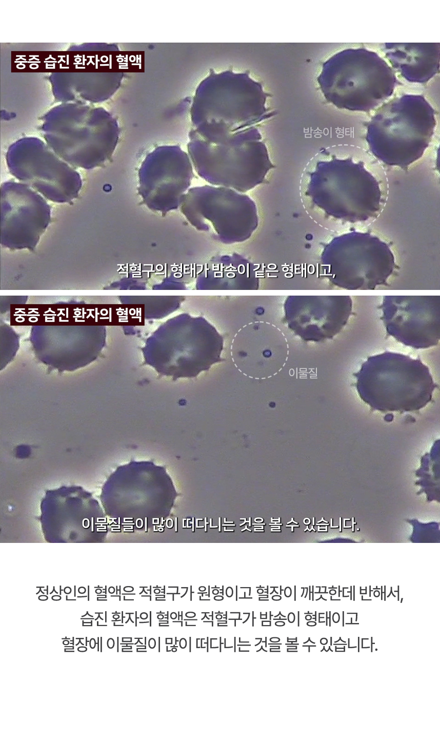 정상인의 혈액은 적혈구가 원형이고 혈장이 깨끗한데 반해서, 습진 환자의 혈액은 적혈구가 밤송이 형태이고 혈장에 이물질이 많이 떠다니는 것을 볼 수 있습니다.