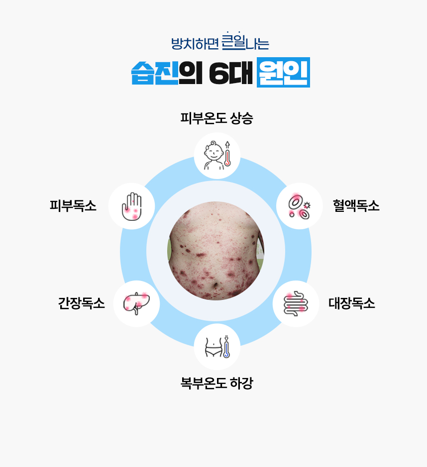 또한 습진 증상이 있는 피부 온도는 높게 상승되어 있고 복부 온도는 낮게 하강되어 있는 병리적인 특성이 있어 이 6가지를 습진이 발병하는 6대 원인으로 보고 있습니다.