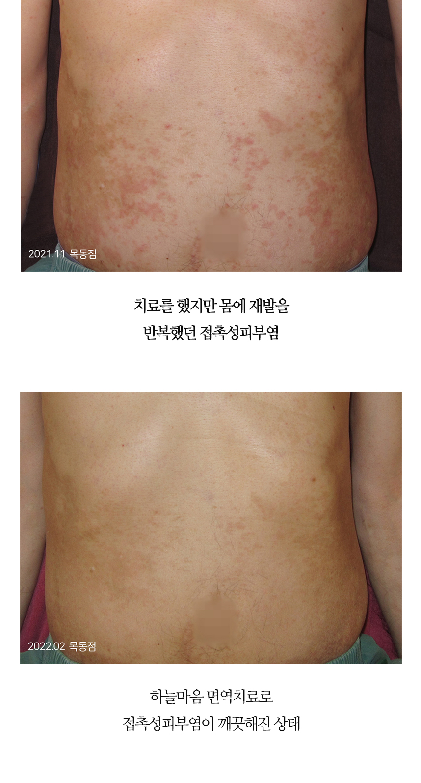 치료전후 이미지4