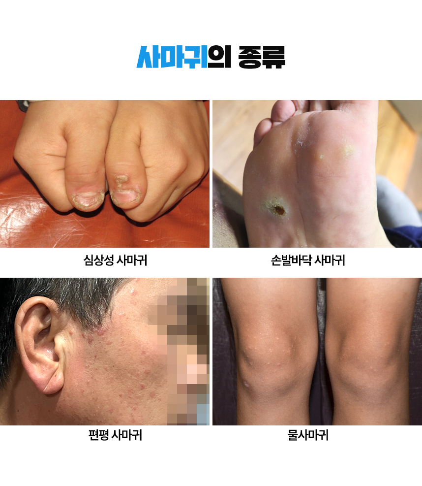 사마귀의 종류