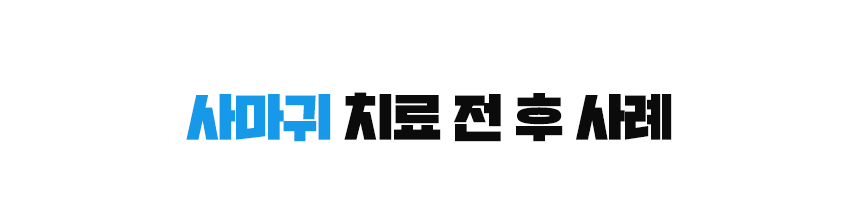 사마귀 치료 전 후 사례