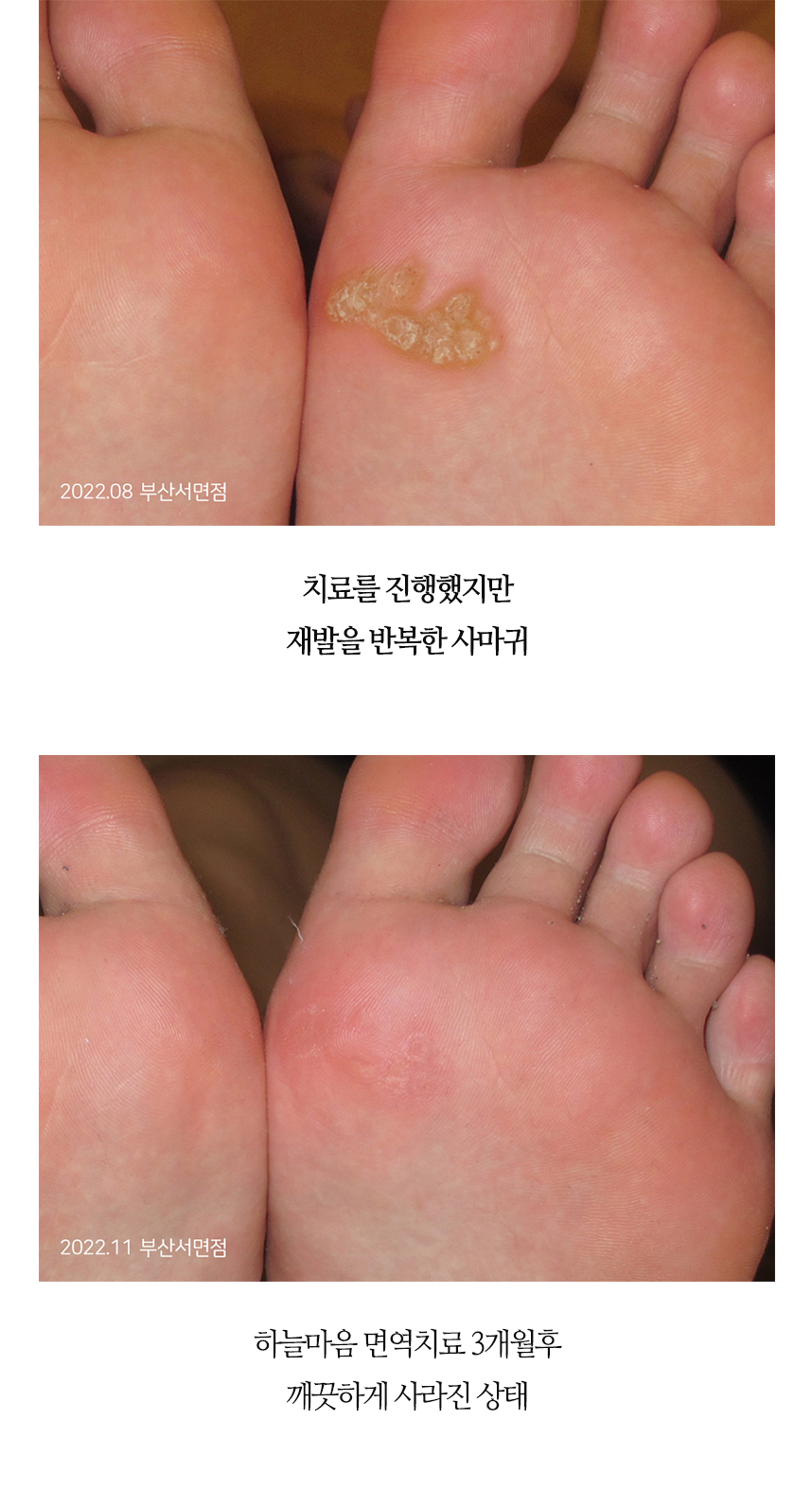 치료전후 이미지1