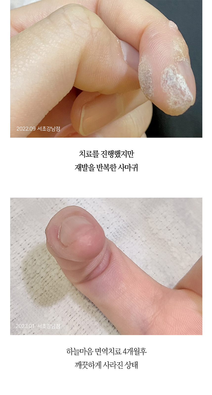 치료전후 이미지2