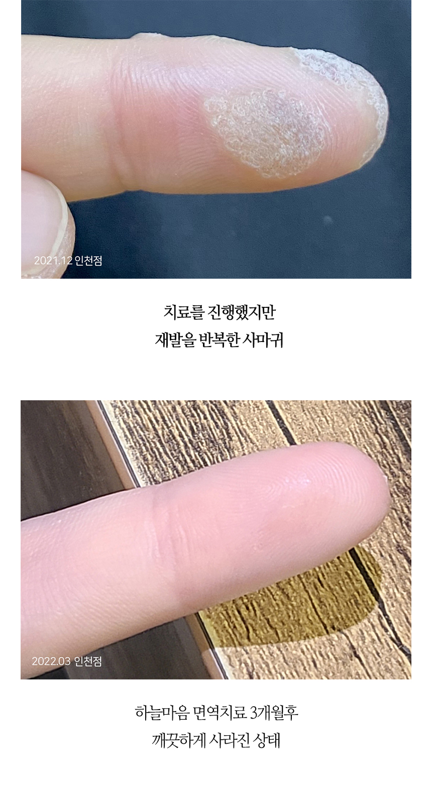 치료전후 이미지3