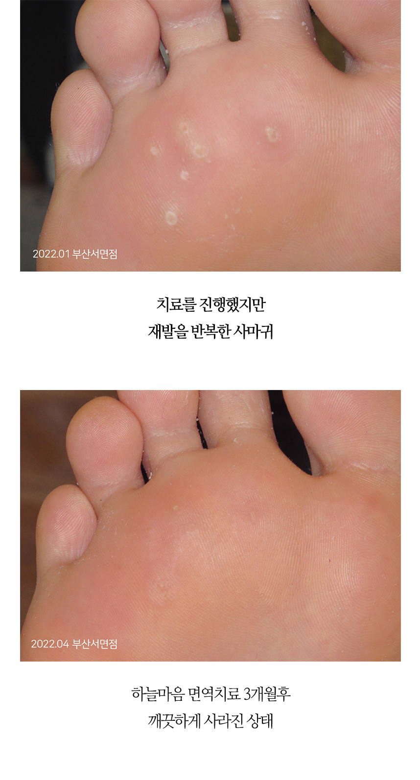 치료전후 이미지4