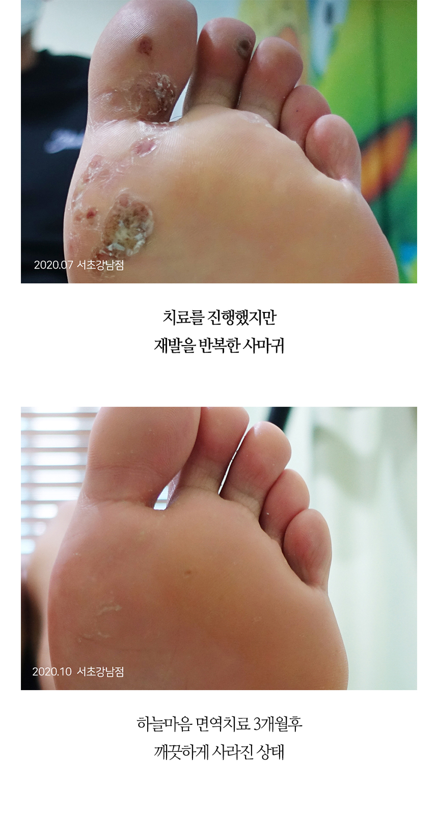 치료전후 이미지5