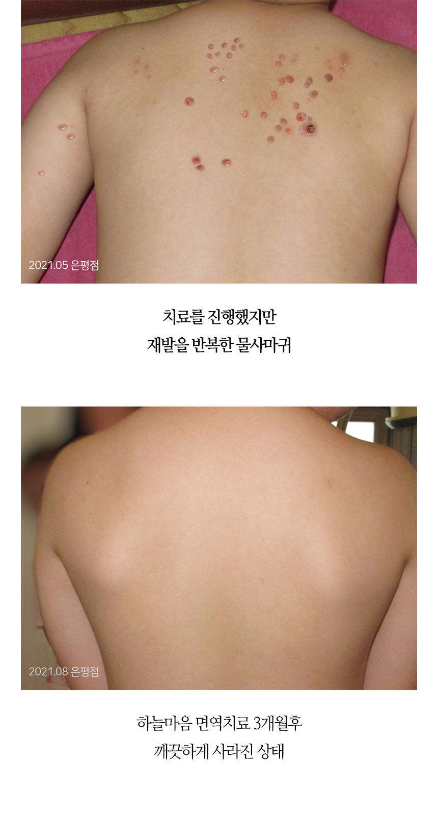 치료전후 이미지6