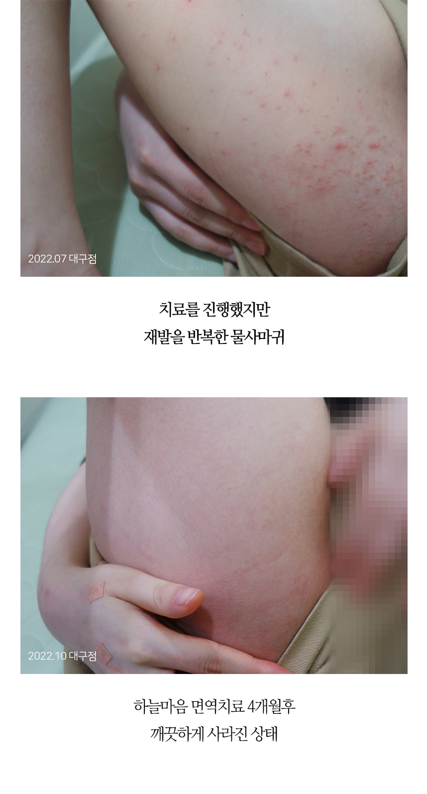 치료전후 이미지7