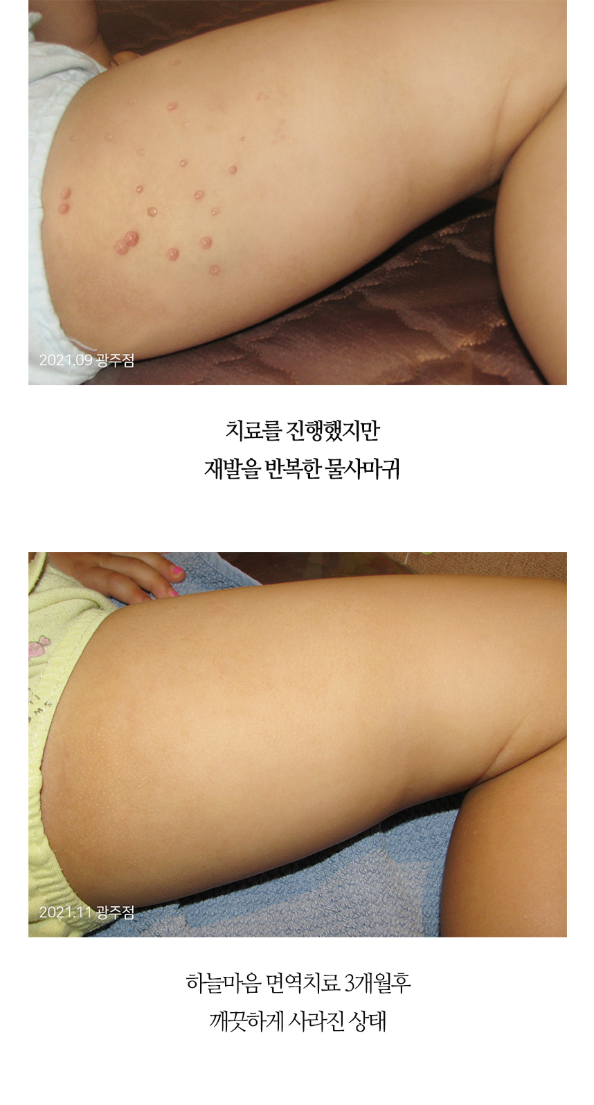 치료전후 이미지8