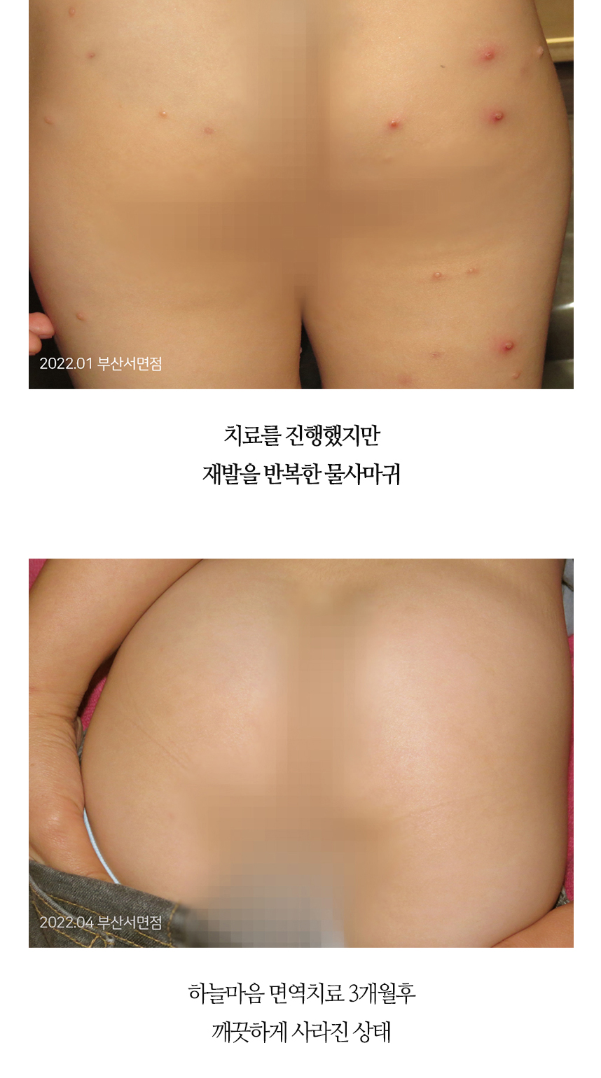 치료전후 이미지9