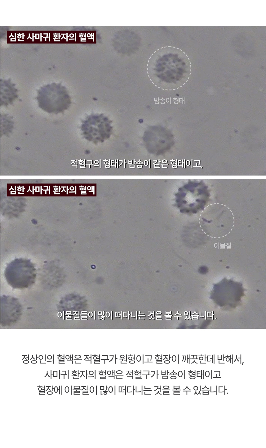 정상인의 혈액은 적혈구가 원형이고 혈장이 깨끗한데 반해서, 사마귀 환자의 혈액은 적혈구가 밤송이 형태이고 혈장에 이물질이 많이 떠다니는 것을 볼 수 있습니다.