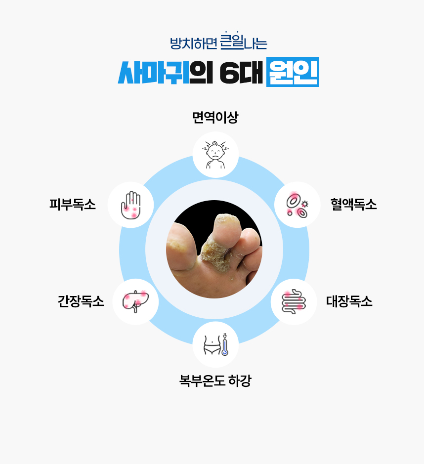 또한 사마귀 증상이 있는 피부 온도는 높게 상승되어 있고 복부 온도는 낮게 하강되어 있는 병리적인 특성이 있어 이 6가지를 사마귀가 발병하는 6대 원인으로 보고 있습니다.