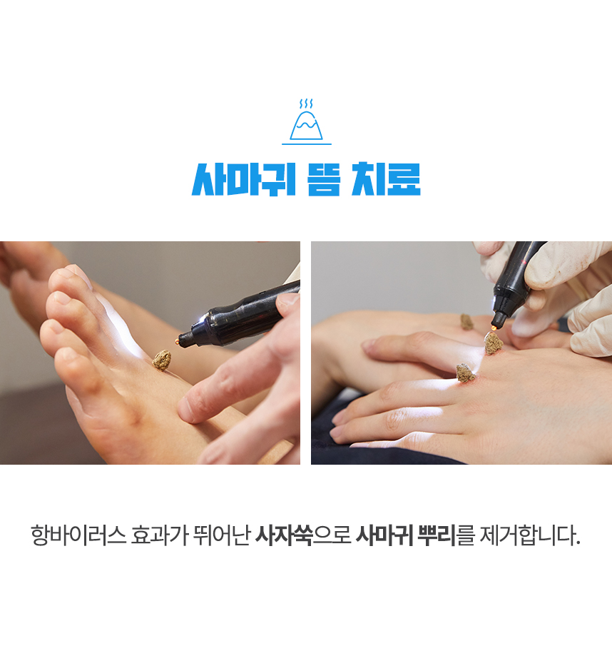 청열뜸치료