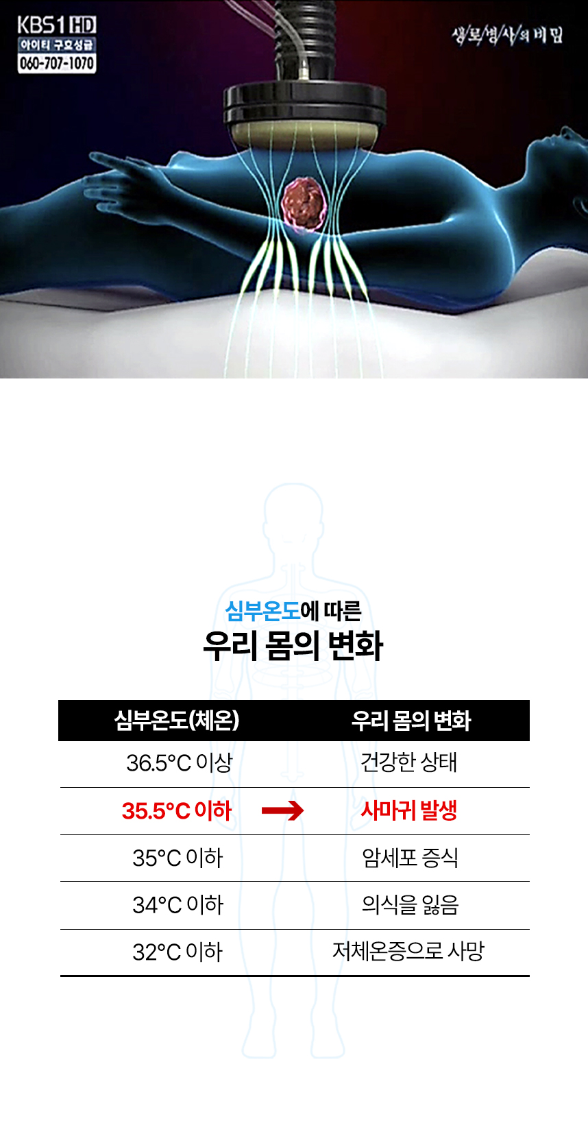심부온도에 따른 우리 몸의 변화 표. 35.5도 이하인 경우 사마귀 발생.