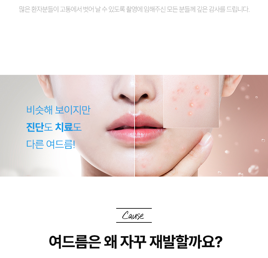 여드름은 왜 자꾸 재발할까요?