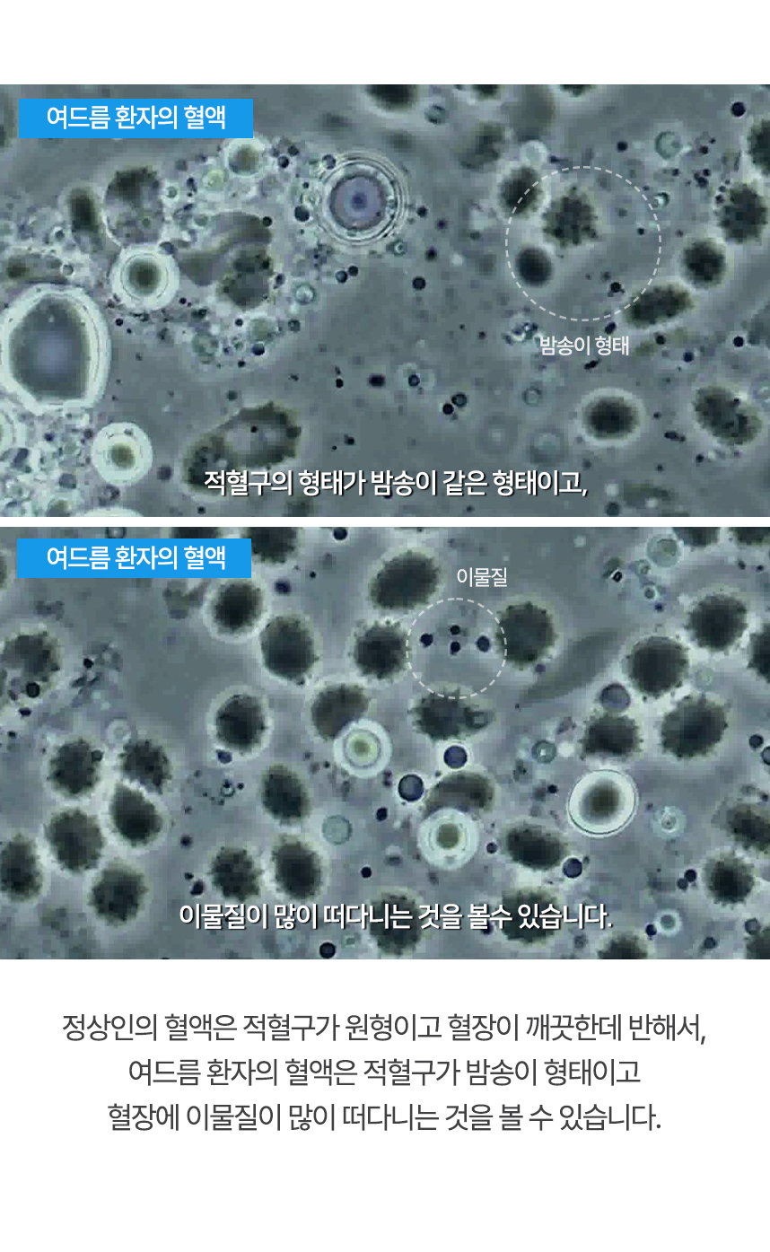 여드름은 환자의 혈액과 정상인의 혈액비교