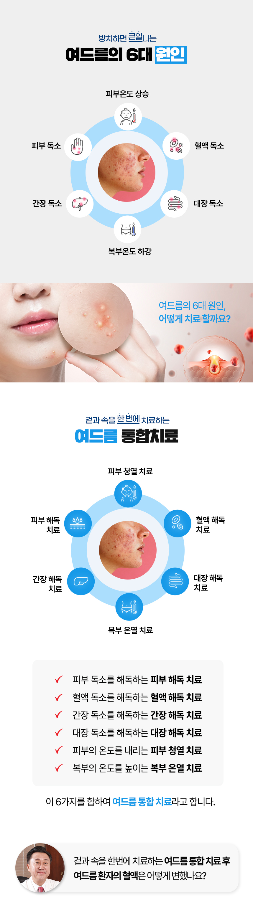 여드름의 6대원인 및 하늘마음한의원 통합치료