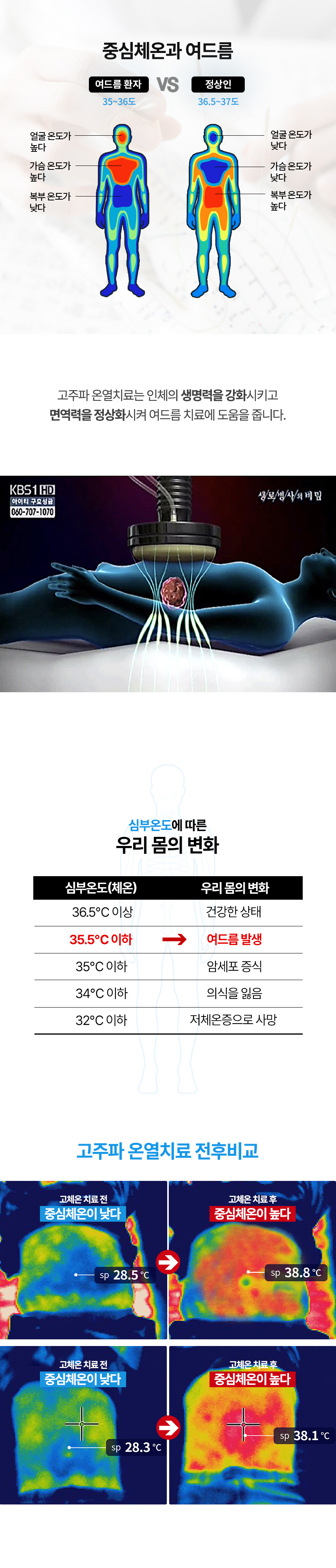 고주파온열치료