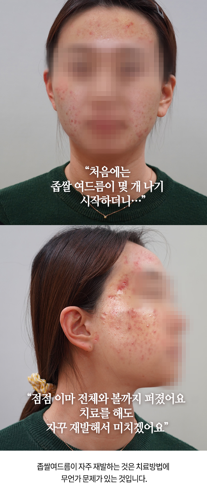 화농성여드름으로 치료를 했지만 효과가 없어요... 흉터가 남을 것 같아 걱정이에요... 굿바이 여드름! 도와드리겠습니다! 하늘마음 화농성 여드름 치료는 다음과 같습니다. 1s 면역강화치료 2n 흉터, 색소침착치료 3c 심장열, 얼굴열, 피부열 치료 4d 피부, 혈액, 간, 장해독 치료