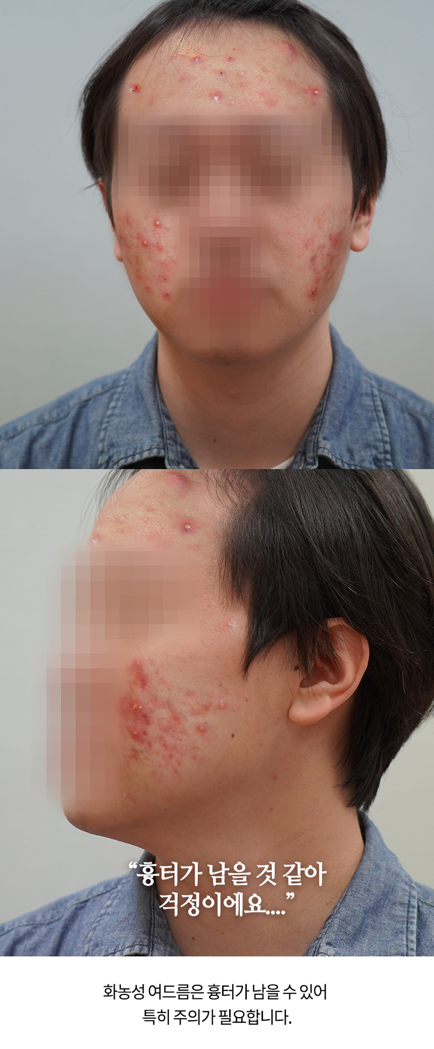 처음에는 좁쌀 여드름이 생기더니 화농성 여드름이 되고 이제 흉터까지 생겼어요... 여드름 화농 때문에 얼굴이 따끔따끔, 쓰라리고... 굿바이 여드름! 도와드리겠습니다. 하늘마음 여드름 흉터 치료는 다음과 같습니다. 1S 면역강화 치료 1A 해독침, 흉터침, 새살침치료 3C 심장열, 얼굴열, 피부열 치료 4D 피부, 혈액, 간, 잘 해독치료 2N 흉터, 색소침착 치료 