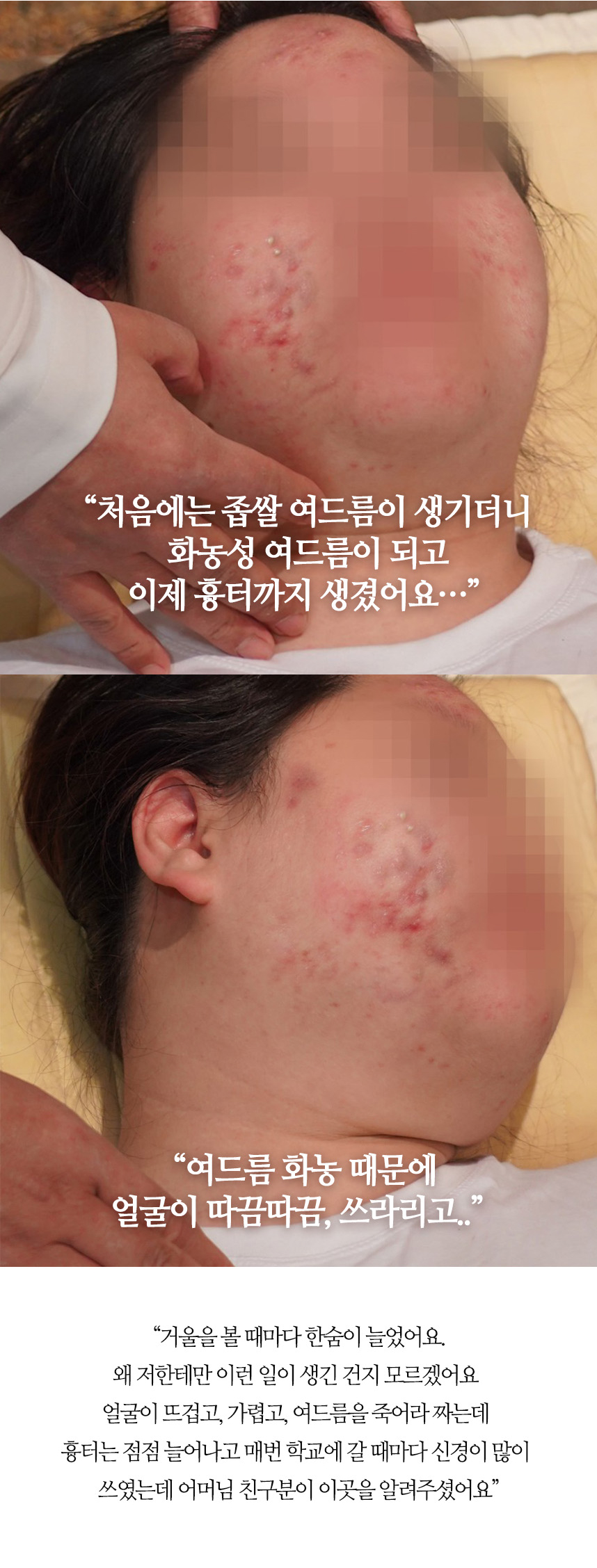 왜 이런 증상이 생겼을까요? 여드름은 관리가 아니라 치료입니다.
