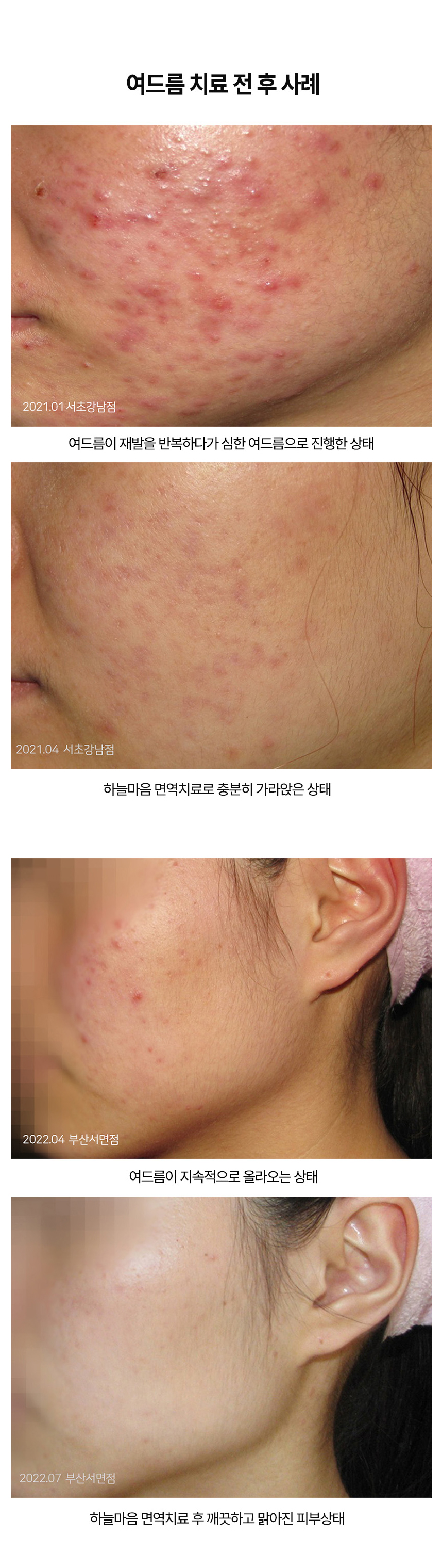치료전후 이미지1