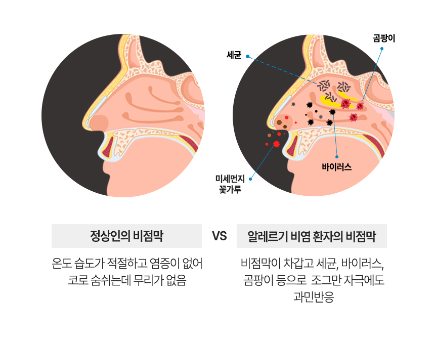 정상인의 비점막 : 온도 습도가 적절하고 염증이 없어 코로 숨쉬는데 무리가 없음. 비염환자의 염증이 생긴 비점막 : 비점막이 차갑고 세균, 바이러스, 곰팡이 등으로  조그만 자극에도 과민반응
