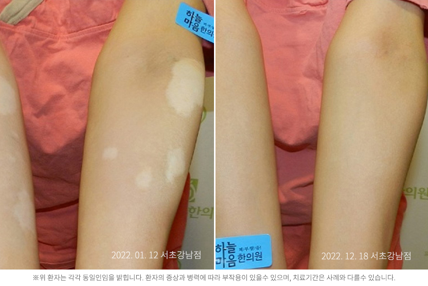 백반증 병력 6년 남아