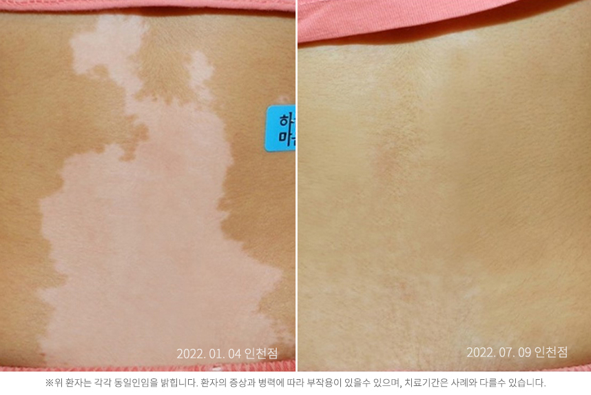백반증 병력 26년 여자