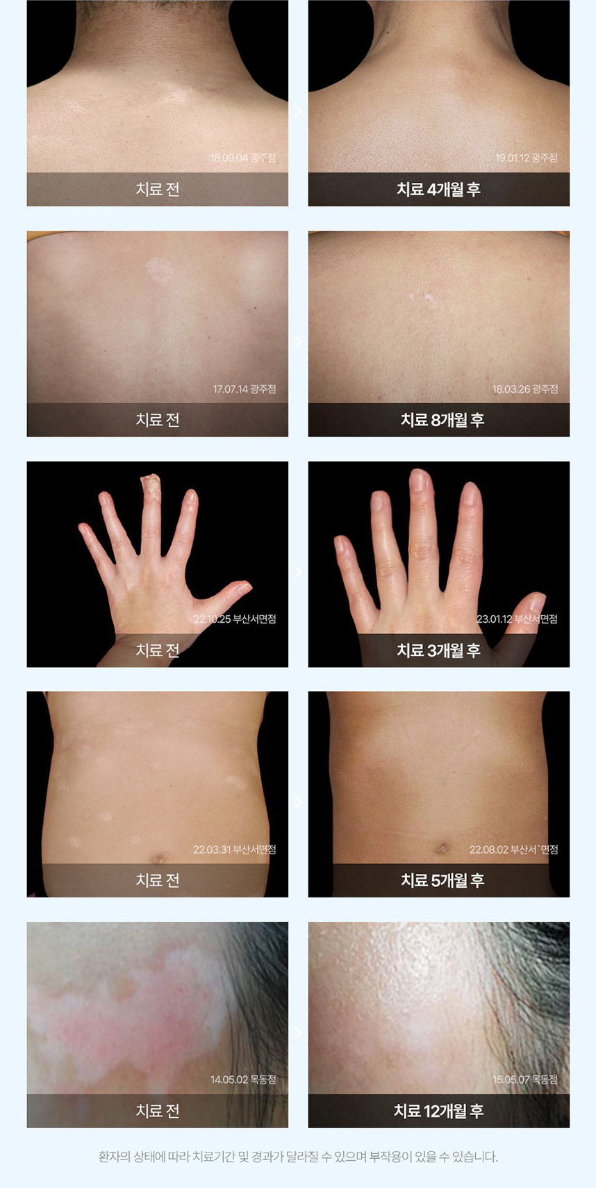 백반증 치료 전후 사례