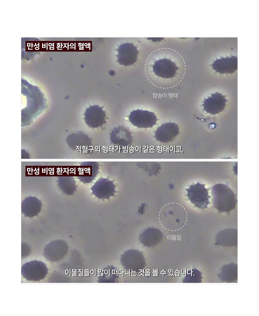 만성 비염 환자의 혈액 : 적혈구의 형태가 밤송이 같은 형태이고, 이물질들이 많이 떠다니는 것을 볼 수 있습니다.