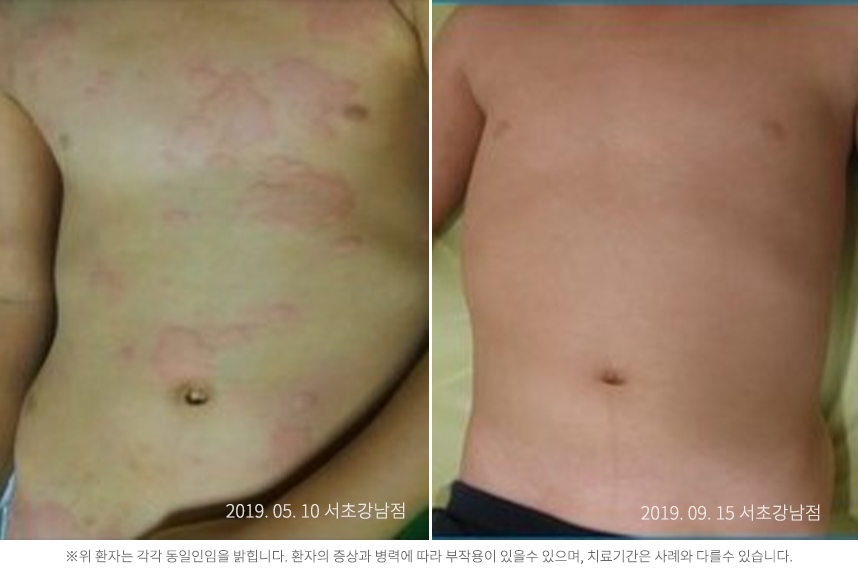 두드러기 병력8개월 10대 남자