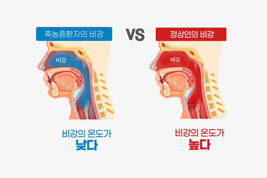 비염환자 : 비강의 온도가 낮다, 정상인 : 비강의 온도가 높다