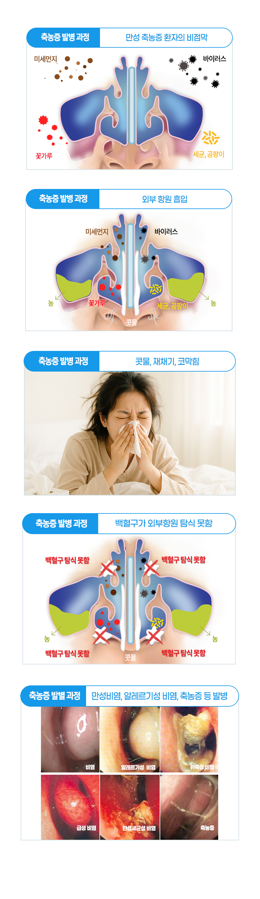 비염 발병 과정 : 외부 항원 흡입 - 콧물, 재채기, 코막힘 - 백혈구가 외부항원 탐식 못함