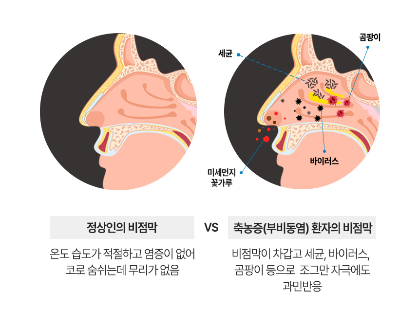 정상인의 비점막 : 온도 습도가 적절하고 염증이 없어 코로 숨쉬는데 무리가 없음. 비염환자의 염증이 생긴 비점막 : 비점막이 차갑고 세균, 바이러스, 곰팡이 등으로  조그만 자극에도 과민반응